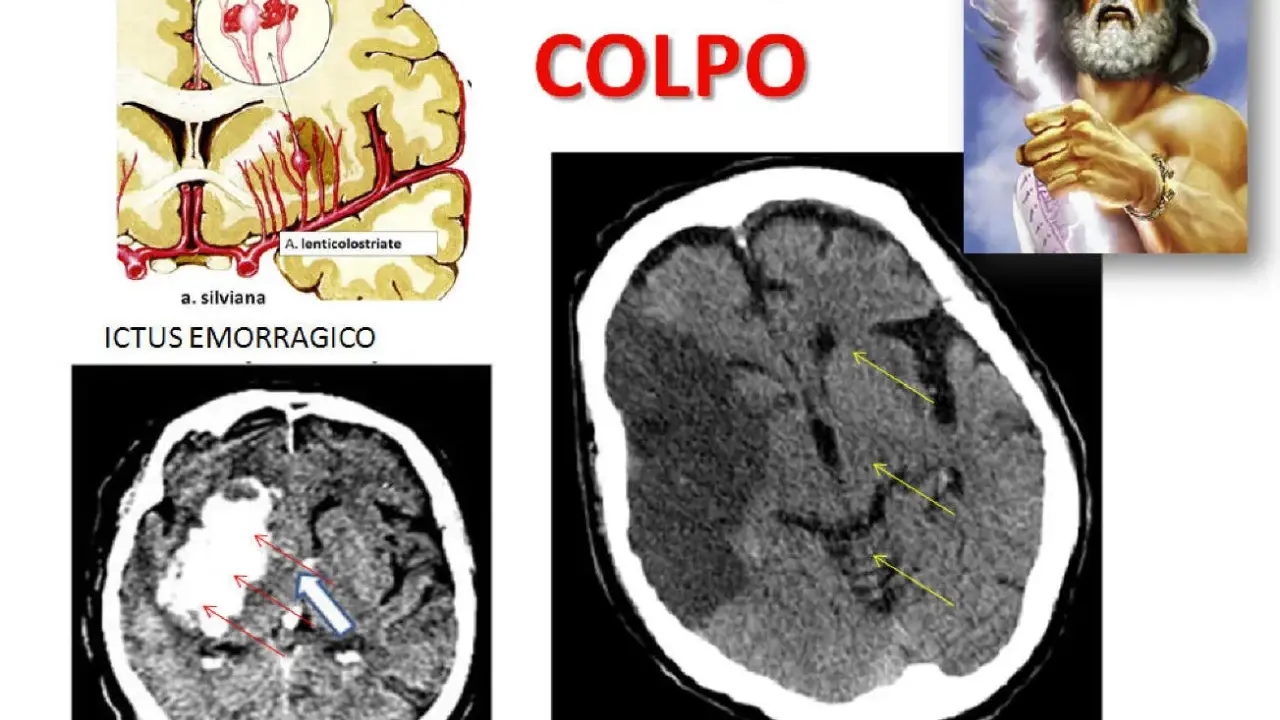 Immagini mediche mostrano ictus cerebrali, emorragici e ischemici. La vasculopatia cerebrale cronica può influenzare l'aspettativa di vita.