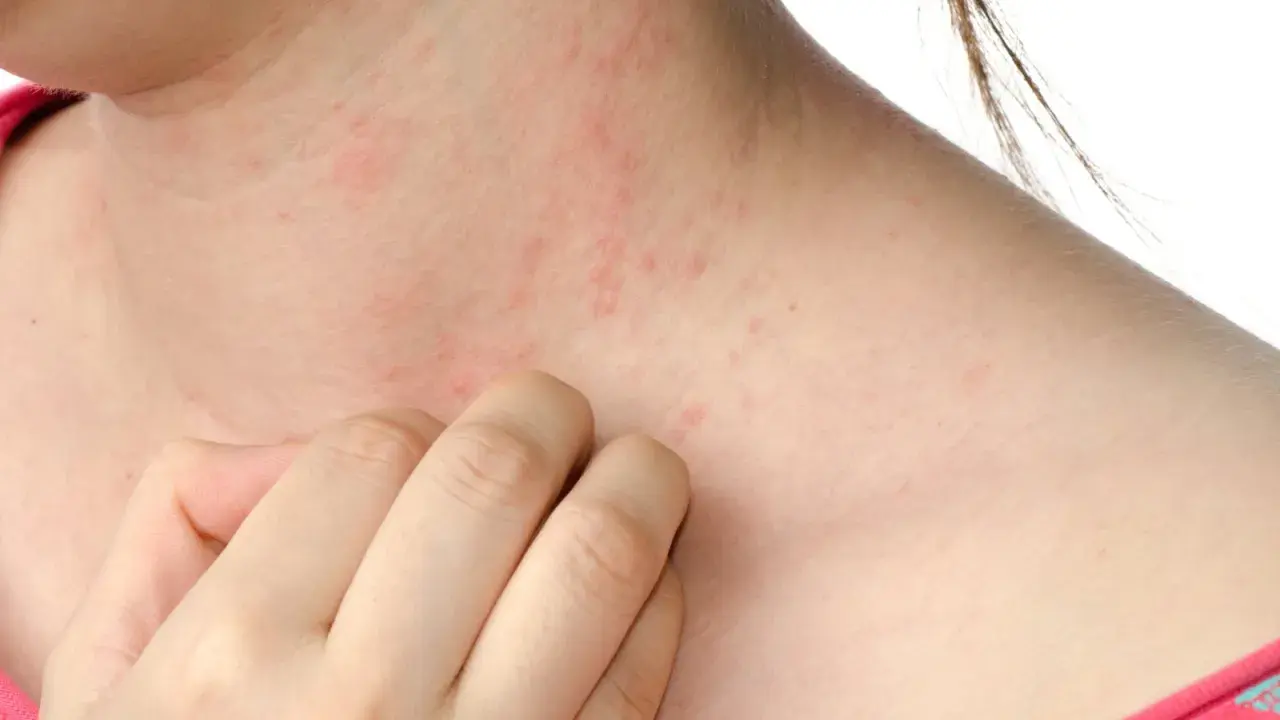 Pelle arrossata e irritata sul collo, con piccole pustole rosse. Una mano si gratta, sintomo di sudore e prurito.
