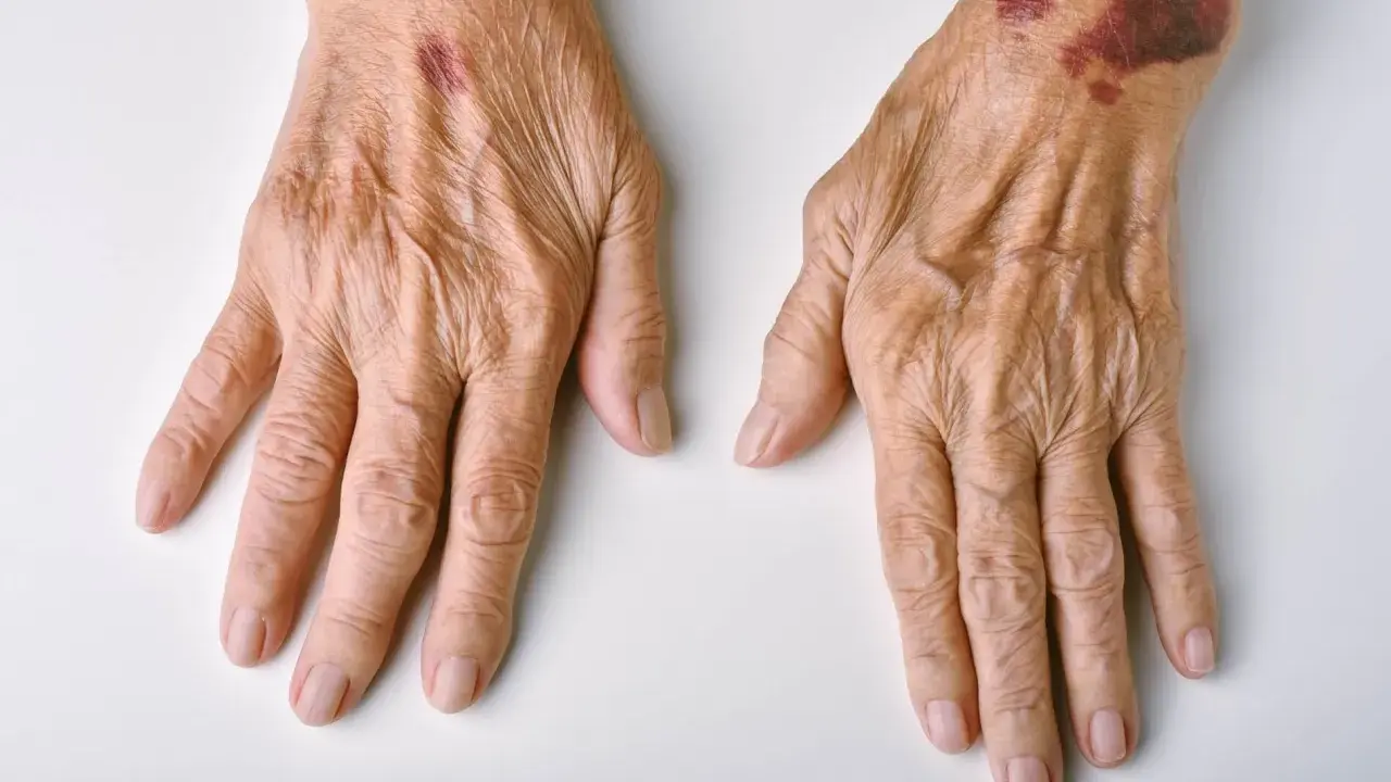 Mani anziane con macchie di sangue sulla pelle, segni di fragilità e fragilità cutanea.
