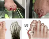 Immagini di piedi con alluce valgo, radiografie e un'illustrazione anatomica. Il dottore dei piedi, l'ortopedico, studia queste condizioni.