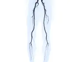 Angiografia delle gambe che mostra l'arteria femorale ostruita, un sintomo di problemi circolatori.