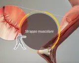 Illustrazione anatomica di uno strappo muscolare, con ingrandimento che mostra la sutura di una lesione muscolare.