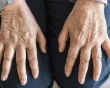Mani anziane con pelle rugosa e vene evidenti, possibili segni di malattie della pelle negli anziani.