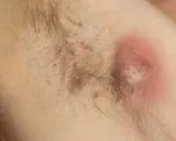Arrossamento sotto le ascelle con pustole e un grosso ascesso infiammato.