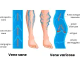 Illustrazione che mostra vene sane e vene varicose, evidenziando i problemi di insufficienza venosa gambe rimedi.