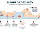 Illustrazione mostra le zone a rischio di piaghe da decubito: testa, spalle, gomiti, schiena, glutei, ginocchia e talloni. Prevenire è il primo passo per curare le piaghe.