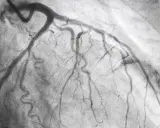 Immagine radiografica del cuore, mostrando le arterie coronarie dopo una coronarografia. Un passo importante nella convalescenza.