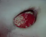 Piaga da decubito sacrale con tessuto necrotico e granulazione. Guida su come curare piaghe da decubito sacrali.