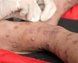 Gambe con lesioni cutanee, forse trattate con scabbia rimedi della nonna. Mani con guanti applicano un trattamento.