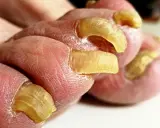 Primo piano di unghie doppie sui piedi, con pelle secca e screpolata.