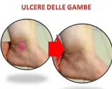 Prima e dopo: ulcere alle gambe che perdono acqua, ora in guarigione.