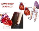 Illustrazione che mostra un cuore normale e ingrossato, un paziente con sintomi di scompenso cardiaco e fluidi polmonari. Lo scompenso cardiaco può regredire con cure adeguate.