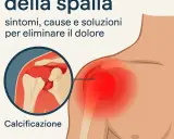 Spalla con tendinite calcifica: ingrandimento mostra calcificazione e area infiammata in rosso. Sintomi, cause e soluzioni per il dolore.