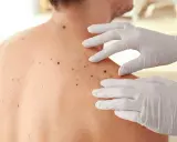 Mani guantate esaminano la schiena di una persona, dove mi stanno spuntando molti nei.