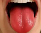 Lingua rossa lucida, un segno che potrebbe indicare cambiamenti nella salute, anche negli anziani.