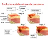 Evoluzione delle piaghe da decubito: da semplice arrossamento a necrosi profonda, mostrando le varie fasi di formazione.
