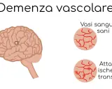 Illustrazione del cervello con un cerchio che indica un'area interessata da vasculopatia cerebrale cronica nell'anziano. Confronto tra vasi sanguigni sani e quelli colpiti da attacchi ischemici transitori.
