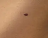 Un neo scuro sulla pelle, un piccolo punto che potrebbe nascondere insidie nei pericolosi.