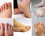 La podologia cos'è? Immagini di piedi con unghie incarnite, talloni screpolati, funghi, calli e gonfiore.