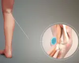 Ingrandimento del ginocchio che mostra una cisti di Baker. Nonostante la cisti, si può camminare.