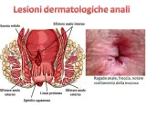 Illustrazione anatomica dell'ano e immagine di una ragade anale, che può causare dermatite perianale.