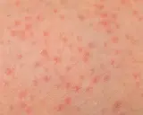 Pelle con prurito alle gambe, caratterizzata da numerosi puntini rossi che indicano un'irritazione cutanea.