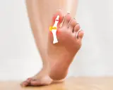 Piede con evidenziato un lieve alluce valgo, con schema osseo e zone rosse di infiammazione.