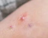 Pelle con arrossamento e piccole vescicole, indicative di dermatite bollosa.