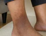 Gambe con macchie scure, segno di problemi di circolazione. La pelle presenta discromie evidenti nella zona della caviglia.