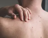 Una mano sfiora la schiena coperta di nei. Un neo irritato, forse dopo che ho grattato un neo ed è uscito sangue, attira l'attenzione.