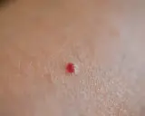 Piccola macchia rossa sulla pelle, un neo rubino che non prude.