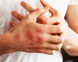 Mani con chiazze rosse e squamose, segno di psoriasi. Nonostante non sia mortale, la psoriasi può avere un impatto devastante sulla qualità della vita.