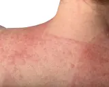 Pelle arrossata e irritata sulla spalla e sul collo, con chiazze evidenti. Potrebbe essere un caso di dermatite da incontinenza.