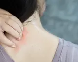 Collo che prude e arrossato, segno di chi ha sudato tanto.