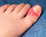 Dito si vede un alluce con unghie piedi curve e arrossate, segno di possibile infiammazione o infezione.