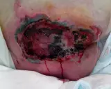 Grave lesione da decubito con tessuto necrotico e sanguinamento. La prevenzione piaghe da decubito è fondamentale per evitare queste condizioni.