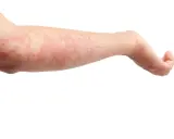 Braccio con eruzione cutanea rossa e pruriginosa, possibile reazione allergica o cause del prurito. Segni a matita sulla pelle.