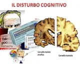 Illustrazione di un cervello atrofico e uno normale, farmaci e un medico che indica il decadimento cognitivo lieve.
