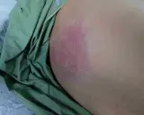 Arrossamento e lesione cutanea, possibile piaga da decubito nera come curarla. Necessario intervento medico.