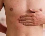 Torso e braccia di una persona con estese irritazioni cutanee rosse e pruriginose.