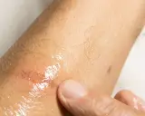 Dito, un dito preme su una lesione cutanea umida e arrossata, forse causata da sudare sempre.
