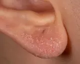 Orecchio con pelle arrossata e desquamata, sintomo di una possibile allergia al nichel.