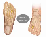 Illustrazione anatomica del piede che mostra un neuroma di Morton, una condizione che rende difficile camminare.