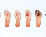 Progressione di ulcere al piede, dalla lieve infiammazione alla necrosi. Immagine illustra come disinfettare le ulcere alle gambe.