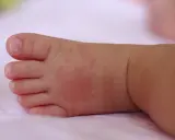 Piedino di neonato con piccoli puntini da sudore rossastri sulla pelle.