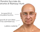 Volto con paralisi facciale da Sindrome di Ramsay Hunt: occhio non chiudibile, sorriso asimmetrico e labbro cadente.