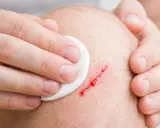 Mano che pulisce una ferita sanguinante sul ginocchio, segno di pelle che si lacera facilmente.