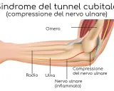 Illustrazione anatomica del gomito che mostra la compressione del nervo ulnare nel tunnel cubitale, con il nervo ulnare infiammato.