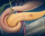 Pancreas con un tumore, che produce enzimi pancreatici. Vicino al duodeno e alla cistifellea.