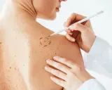 Medico disegna cerchio su neo per asportazione. La convalescenza dopo asportazione neo è un momento delicato.